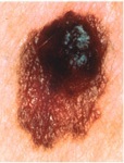Melanoma_Asymmetry