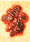 Melanoma_Border