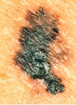 Melanoma_Colour