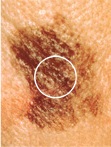 Melanoma_Diameter