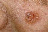 basal_cell_carcinoma basal_cell_carcinoma