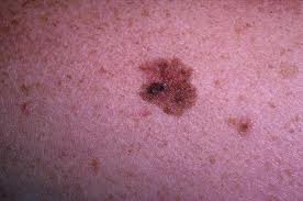 Clinical Melanoma