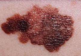 Clinical Melanoma