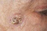 squamous_cell_carcinoma squamous_cell_carcinoma